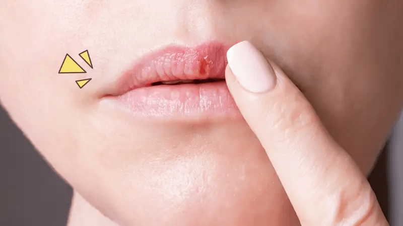 Arti Kedutan Bibir Kiri Atas Menurut Medis dan&nbsp;Primbon!