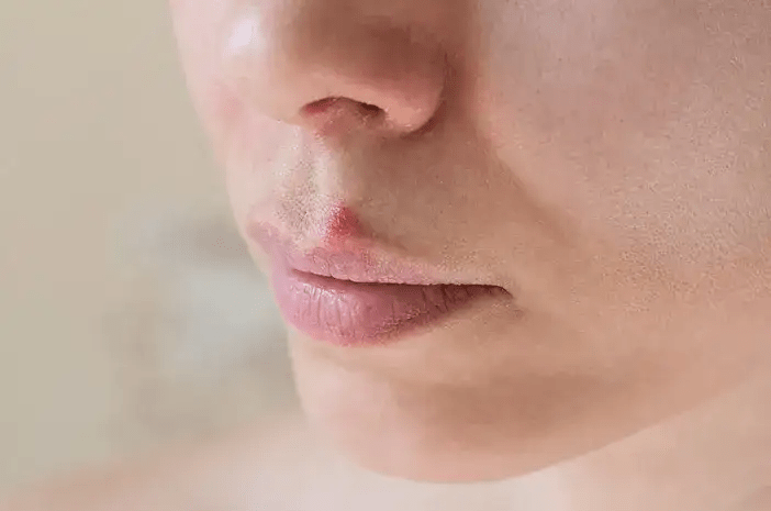 Arti Jerawat di Atas Bibir dan Cara Mengatasinya,&nbsp;Catat!